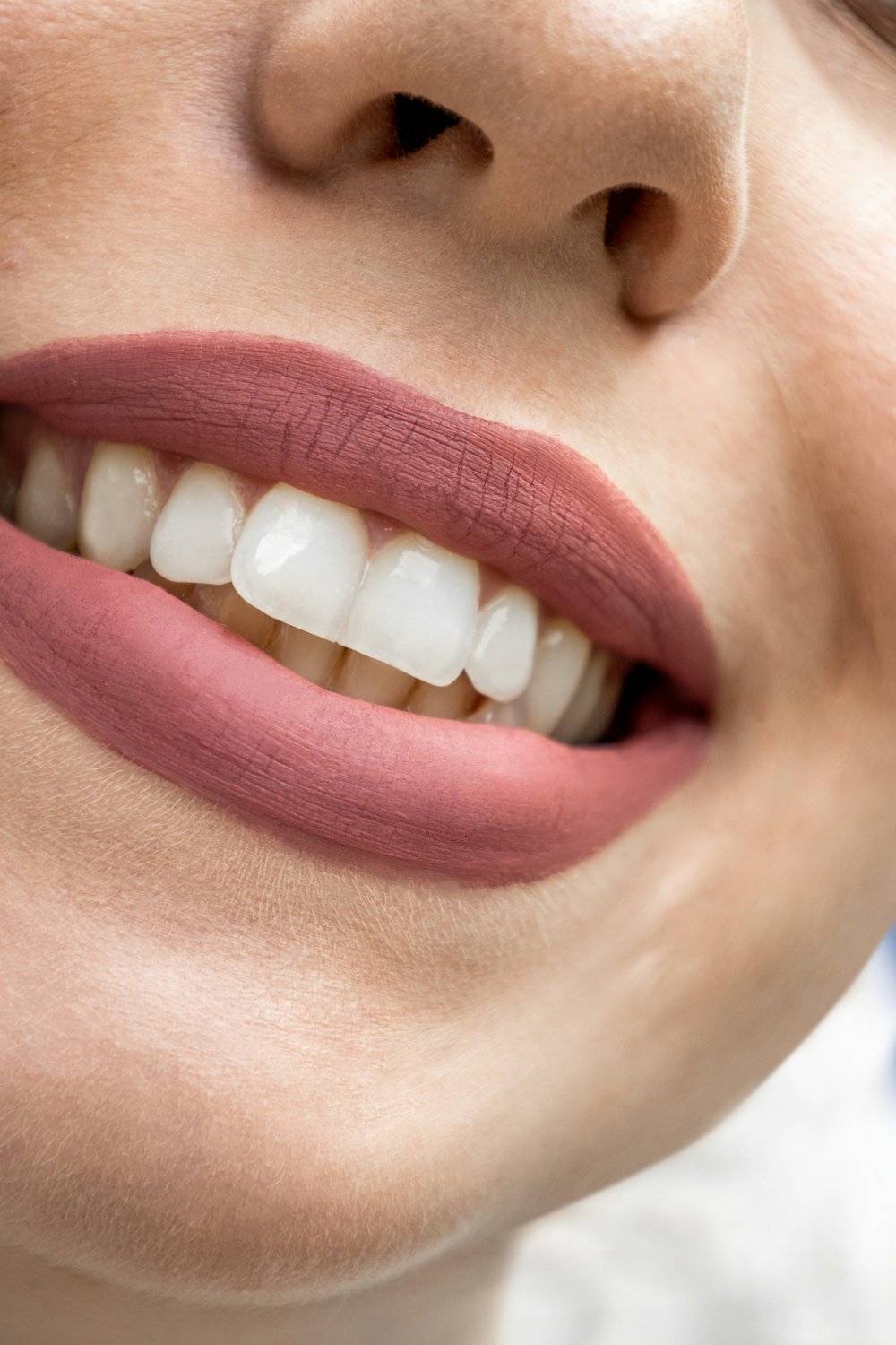 Natural-looking veneers from a Nanaimo cosmetic dentist