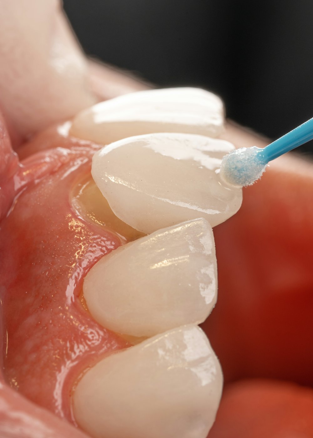 Cosmetic dentist applying a veneer to a prepared tooth