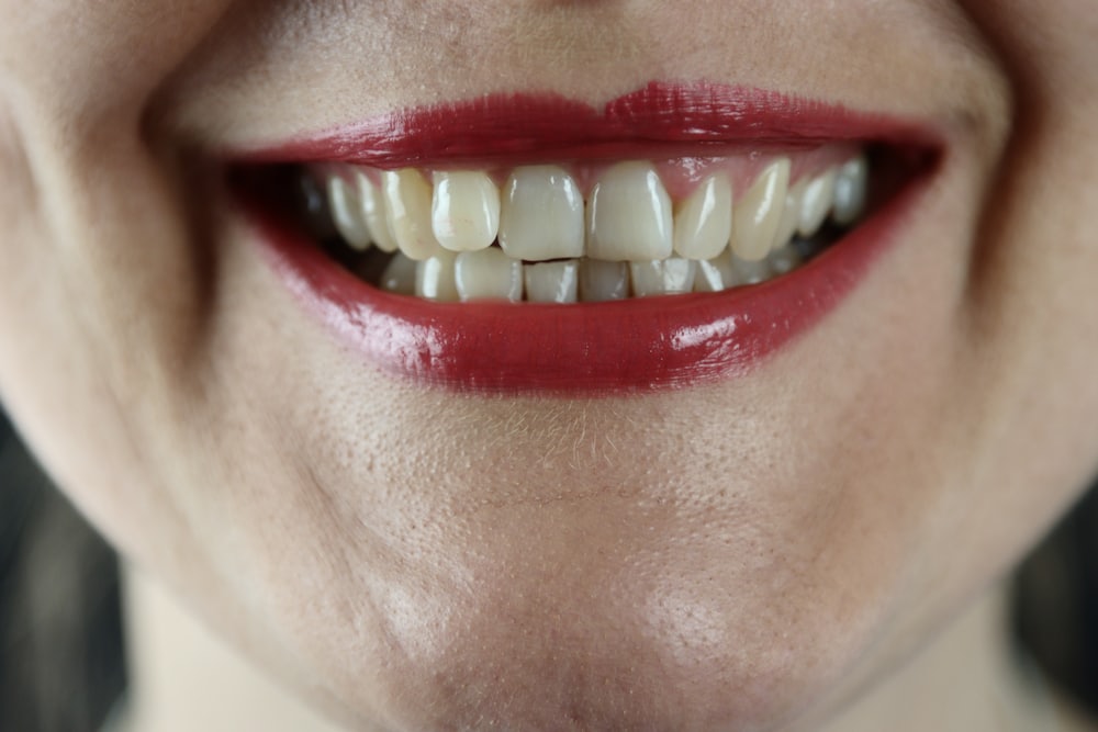 Porcelain veneer shells on a dental model